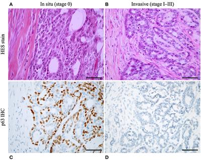 Proposal for a Histological Staging System of Mammary Carcinomas in Dogs and Cats. Part 2: Feline Mammary Carcinomas